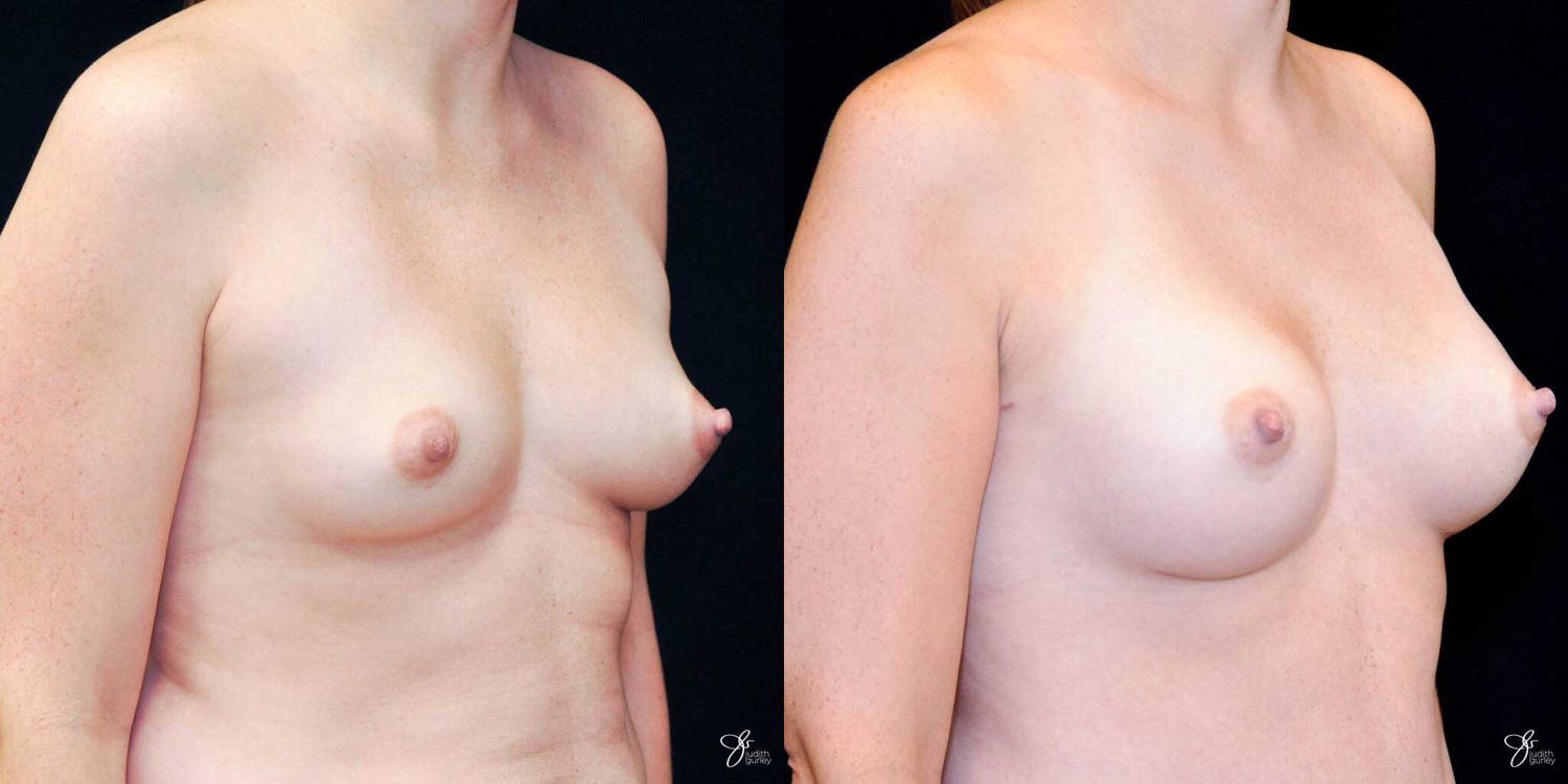 Breast Augmentation Before & After
