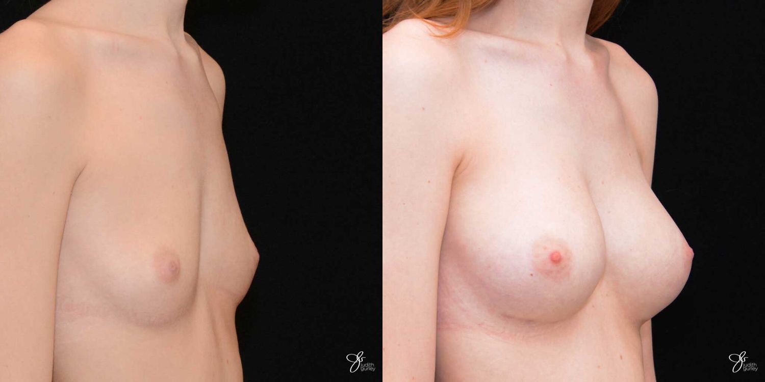 Breast Augmentation Before & After