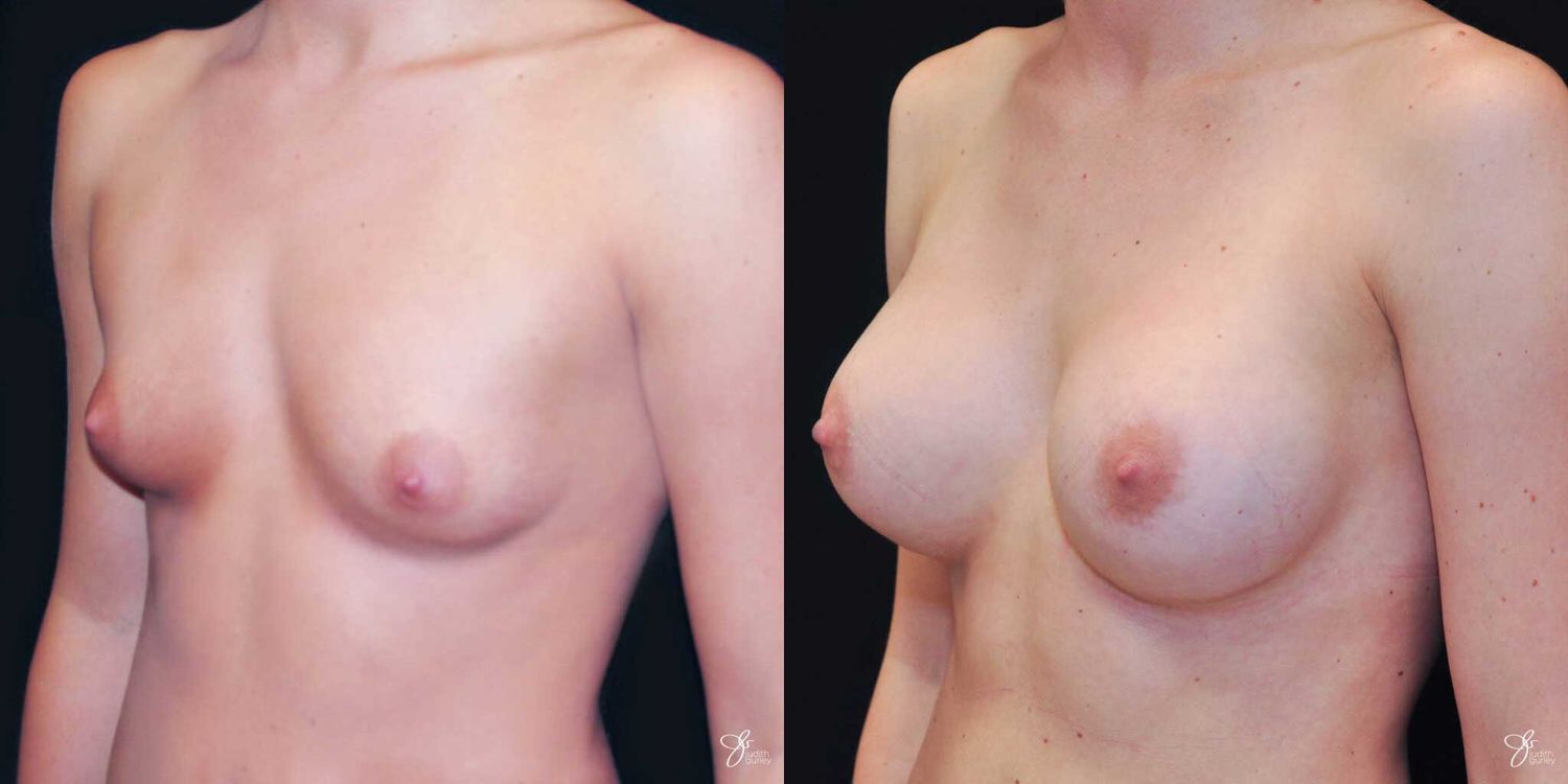Breast Augmentation Before & After