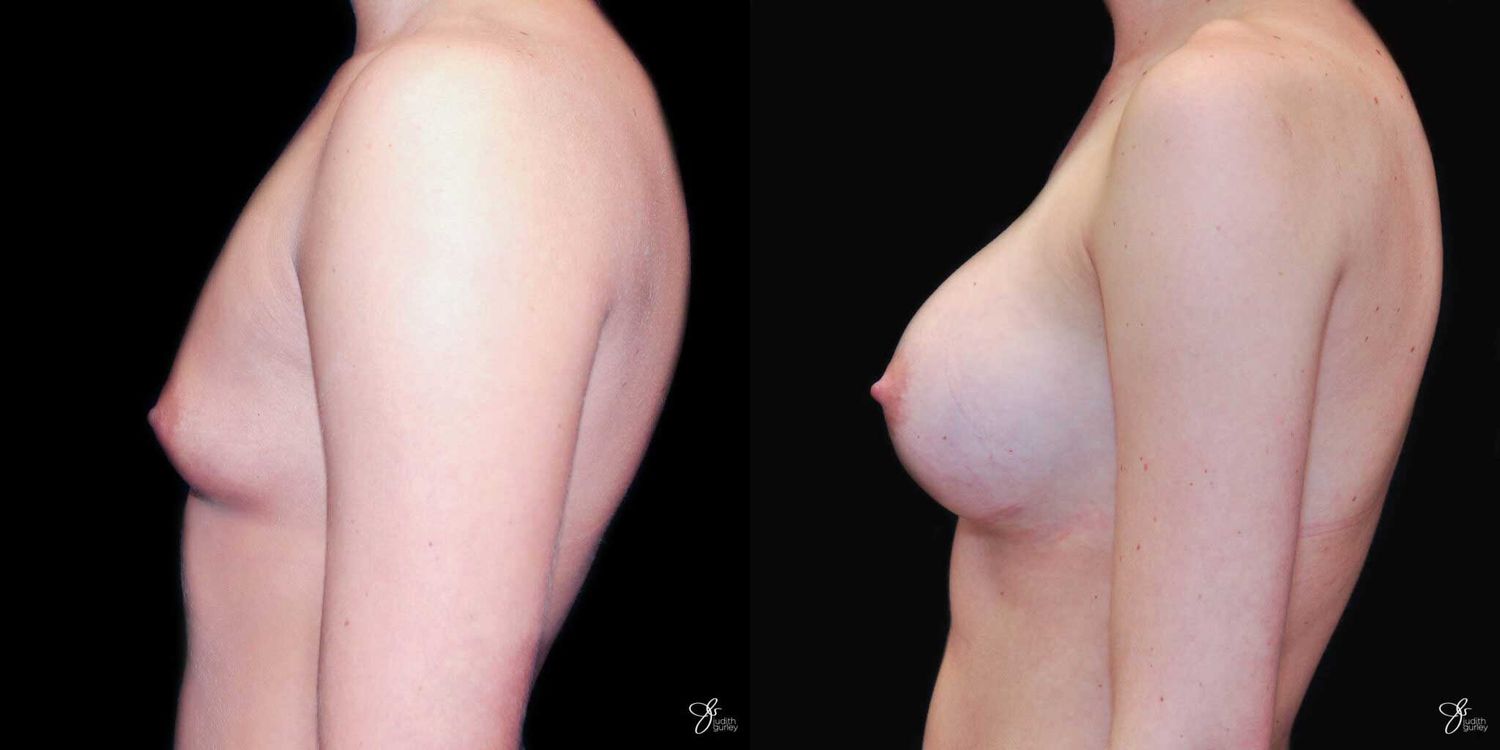 Breast Augmentation Before & After