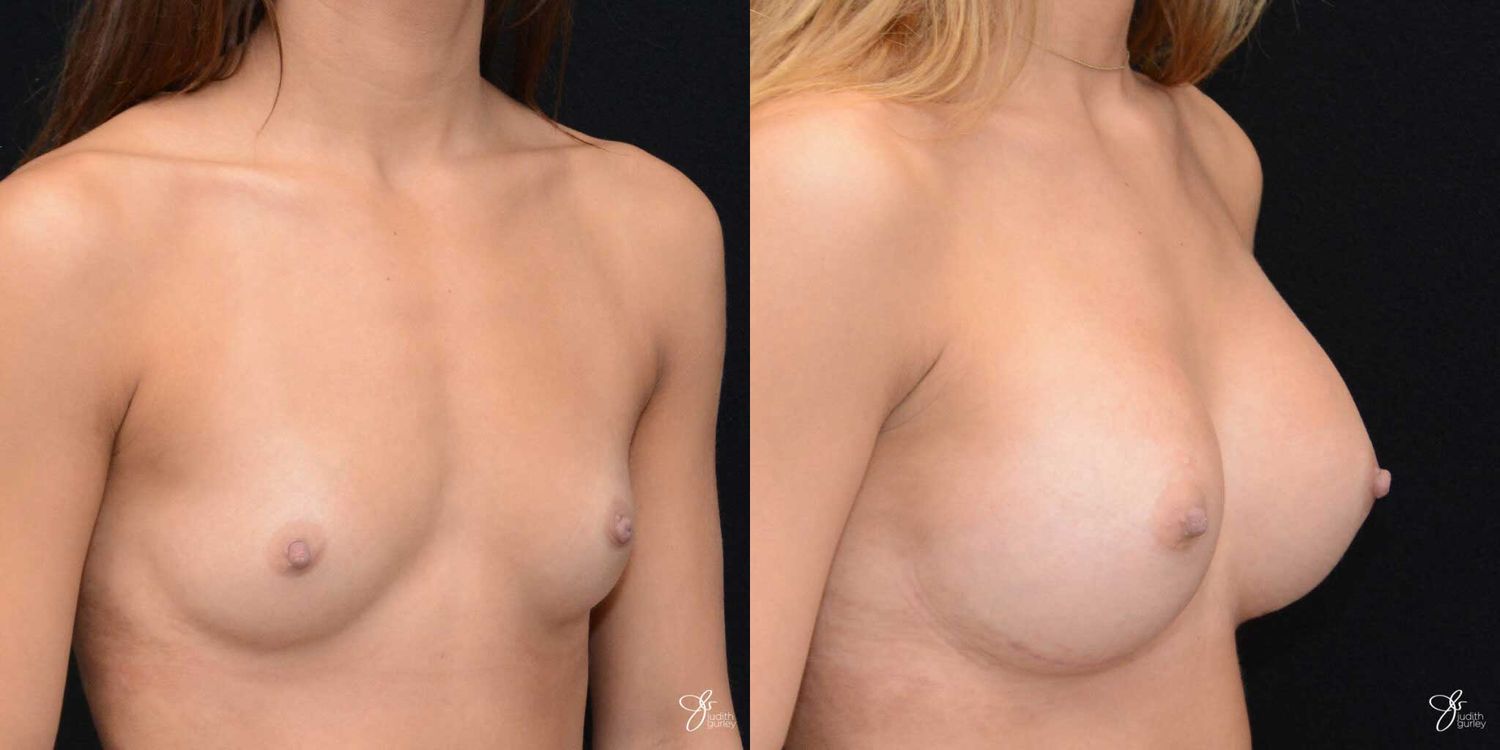 Breast Augmentation Before & After