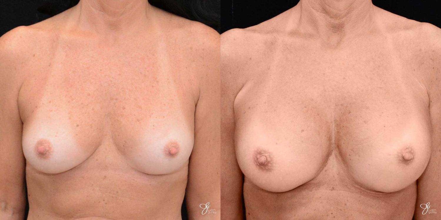 Breast Augmentation Before & After