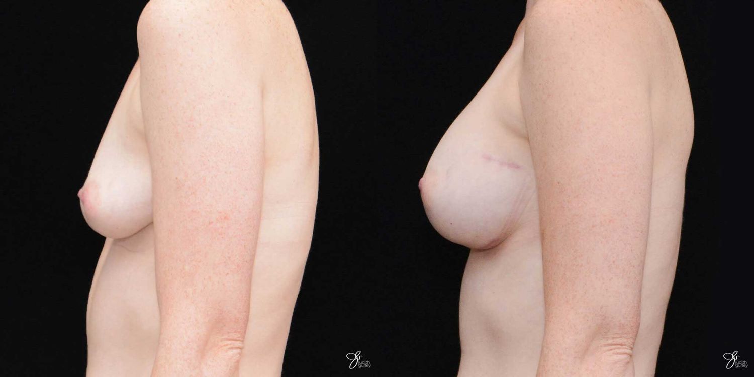 Breast Augmentation Before & After