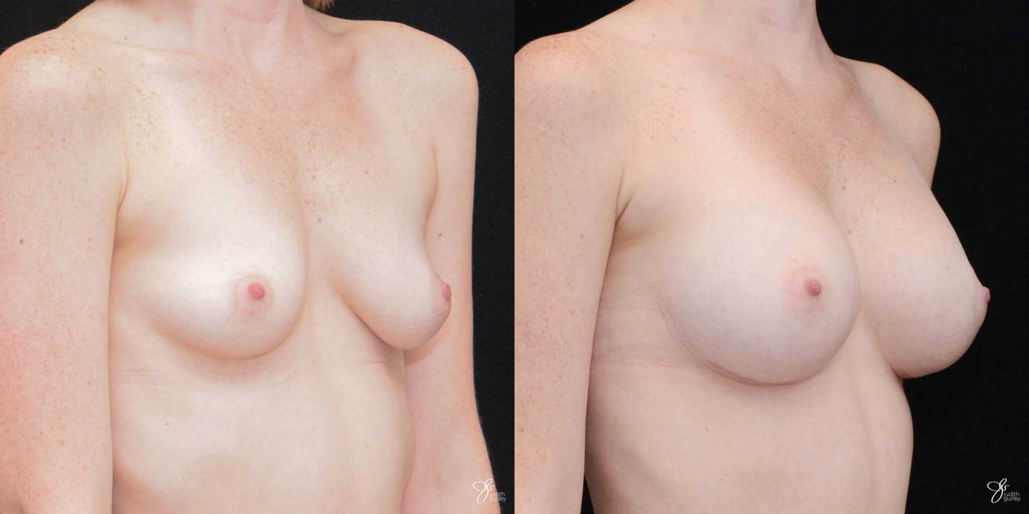 Breast Augmentation Before & After