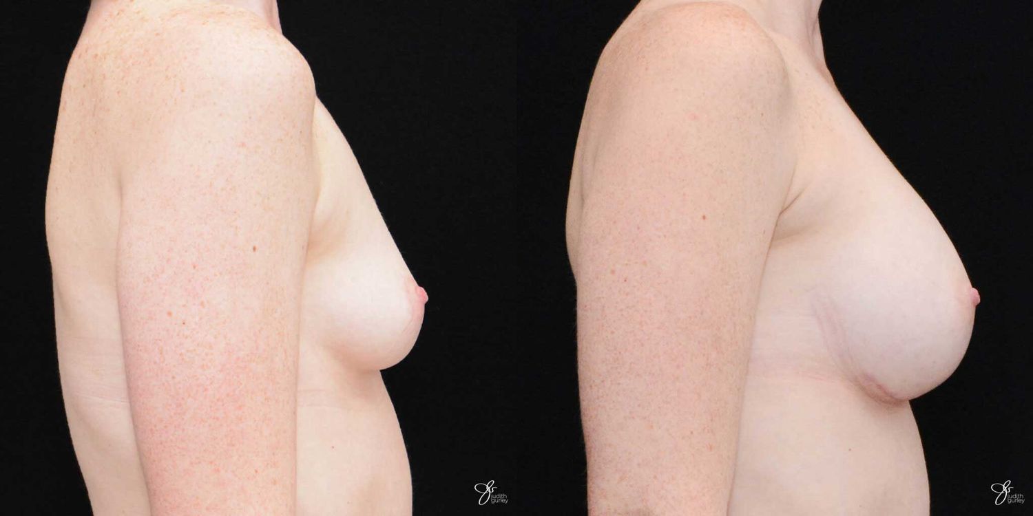 Breast Augmentation Before & After