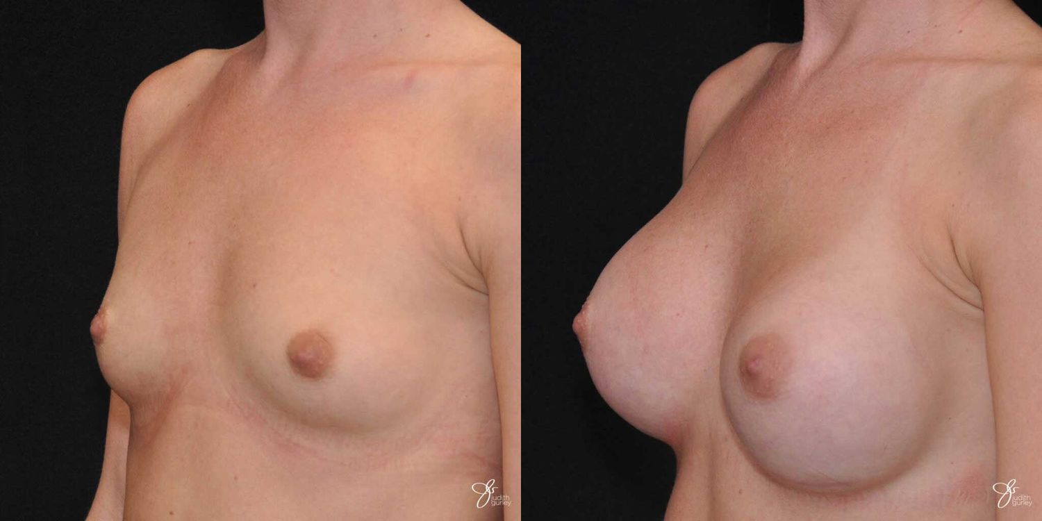 Breast Augmentation Before & After
