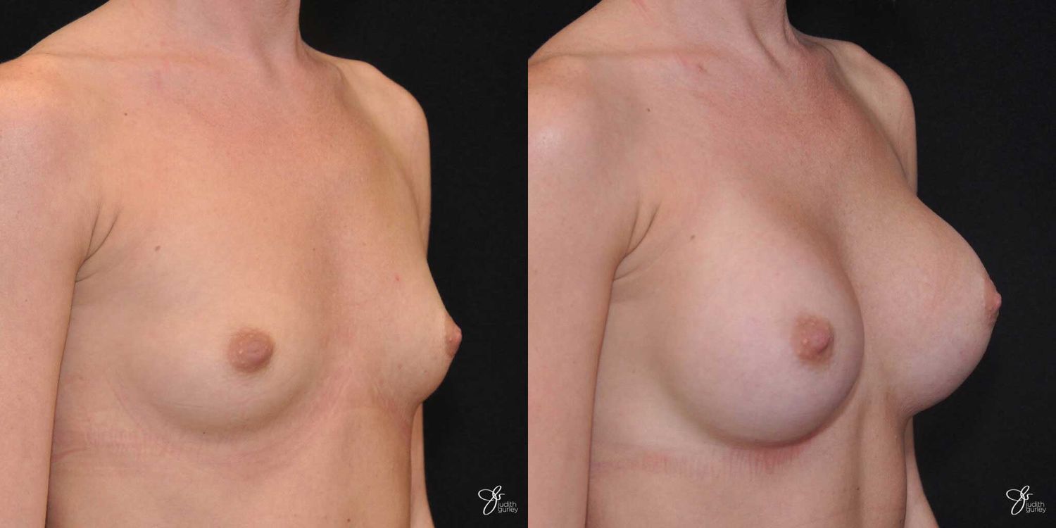 Breast Augmentation Before & After