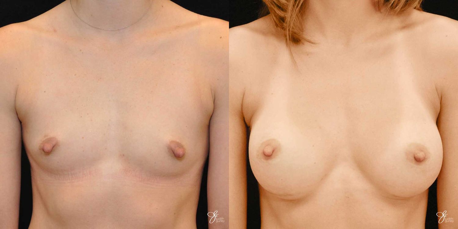 Breast Augmentation Before & After