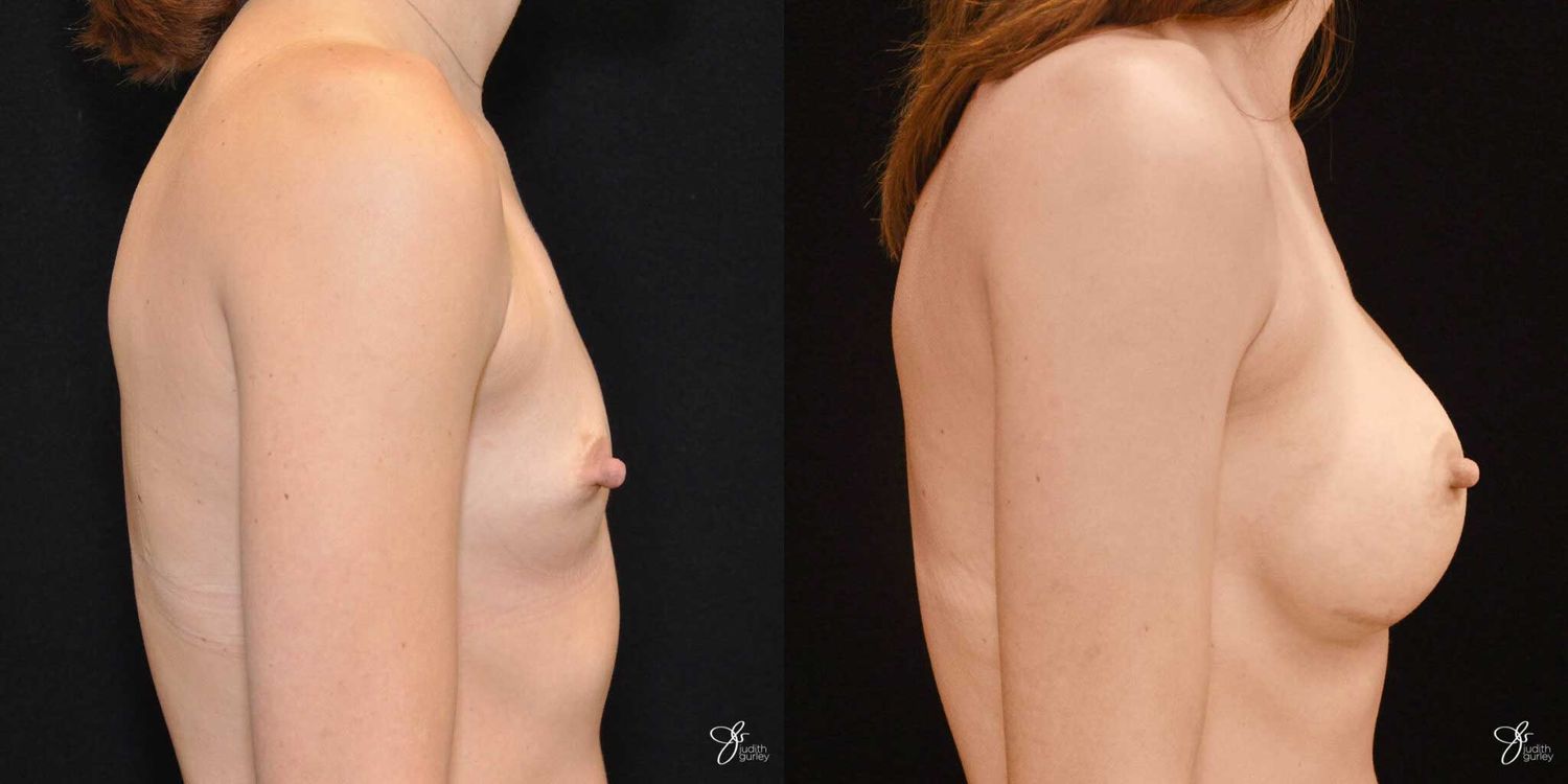 Breast Augmentation Before & After