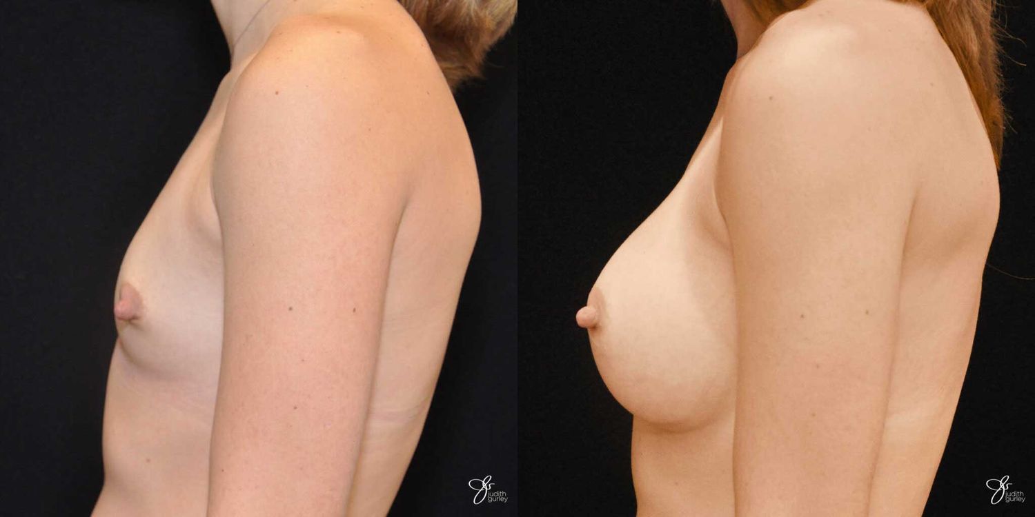 Breast Augmentation Before & After