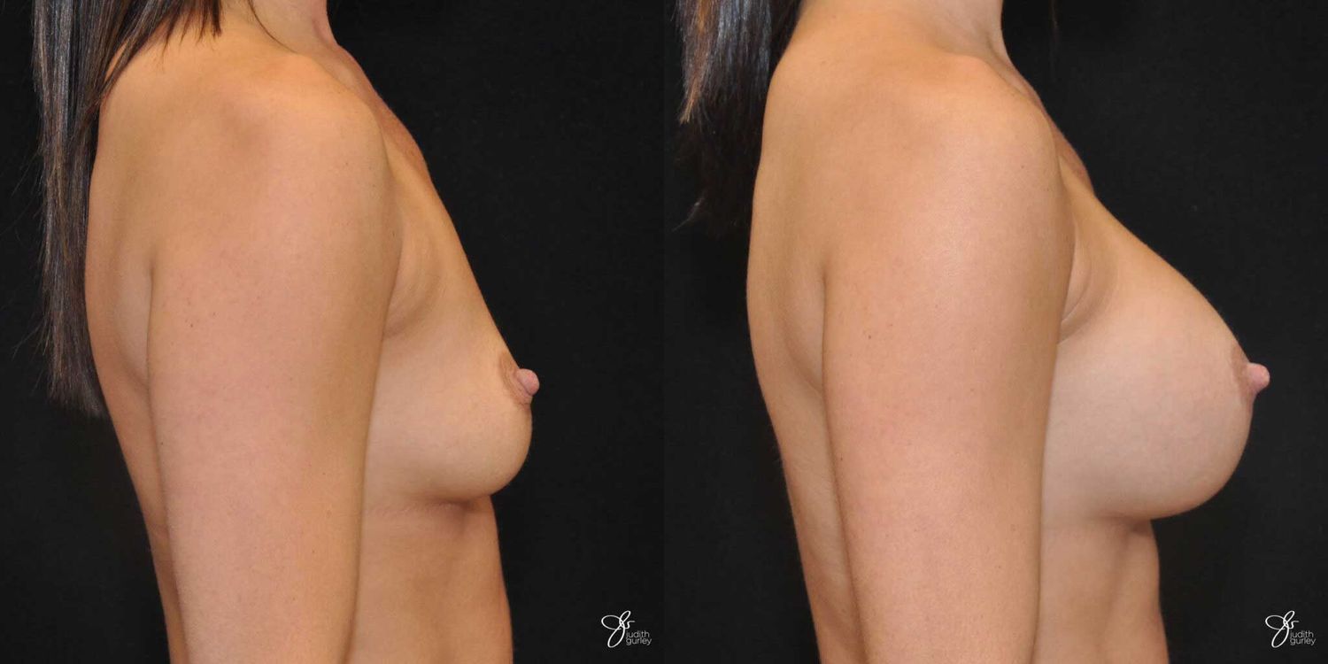 Breast Augmentation Before & After