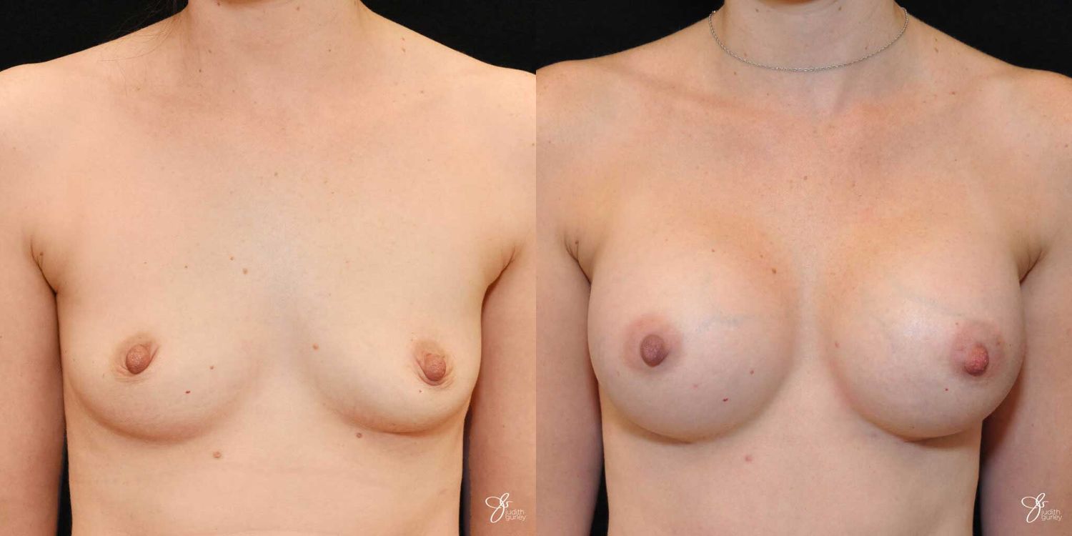 Breast Augmentation Before & After