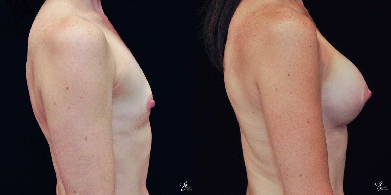 Breast Augmentation Before & After