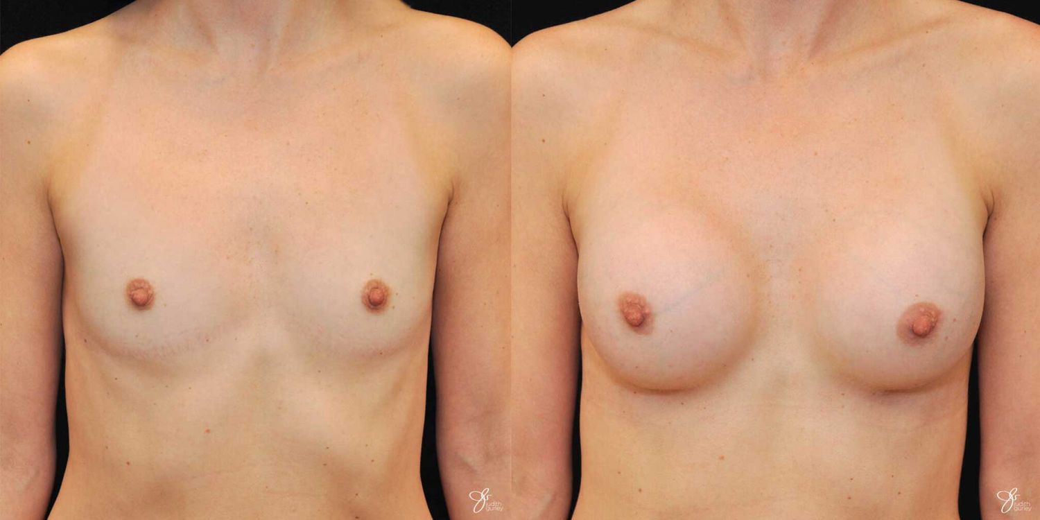 Breast Augmentation Before & After