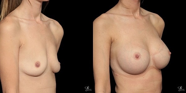 Breast Augmentation Before & After