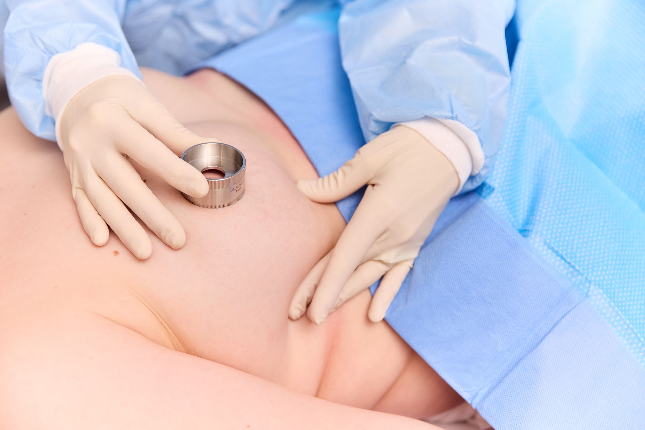 Medical hand examining abdomen with measuring tool.