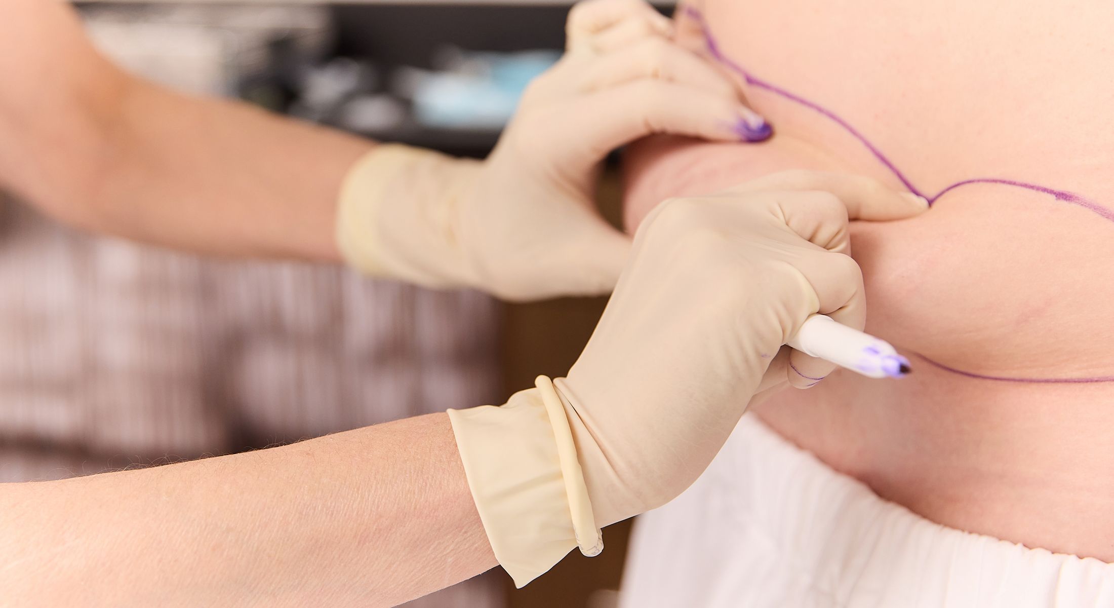 Medical professional marking skin for a procedure.