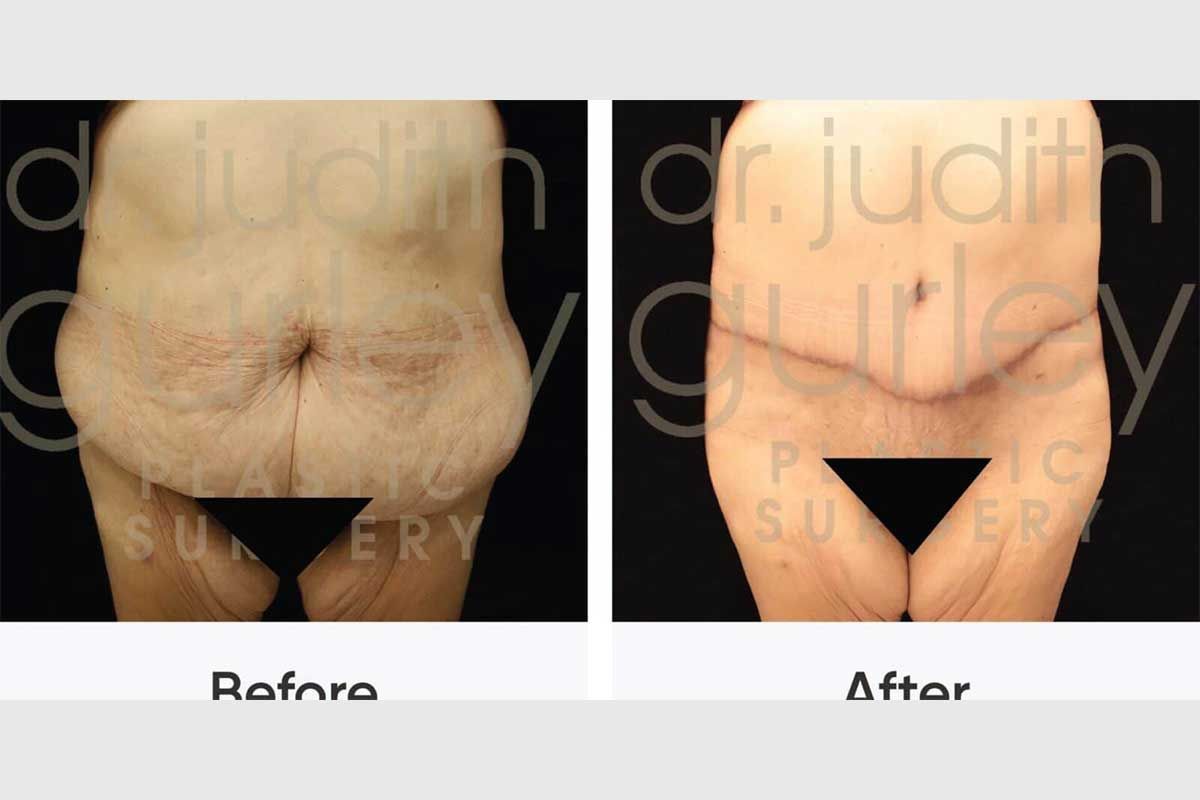 Patient Abdominoplasty Story