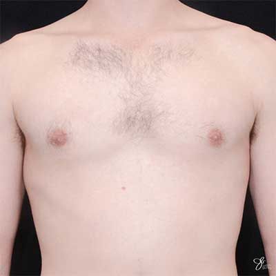 Gynecomastia correction treatment