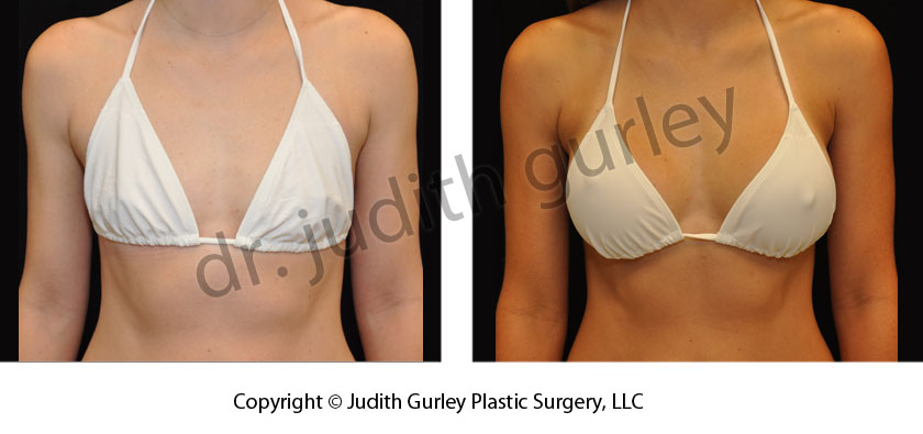 The Perfect Breasts — Breast Augmentation