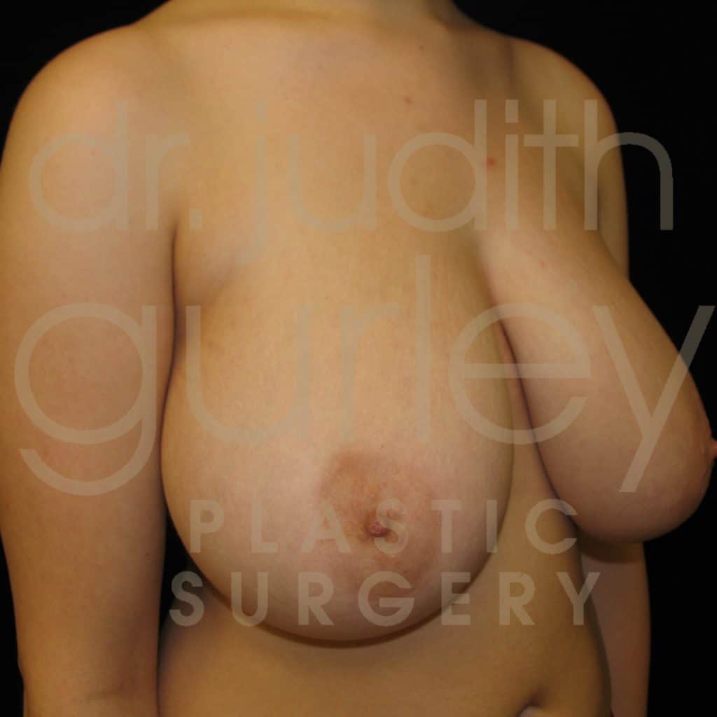 Breast Reduction Surgery Before & After Results