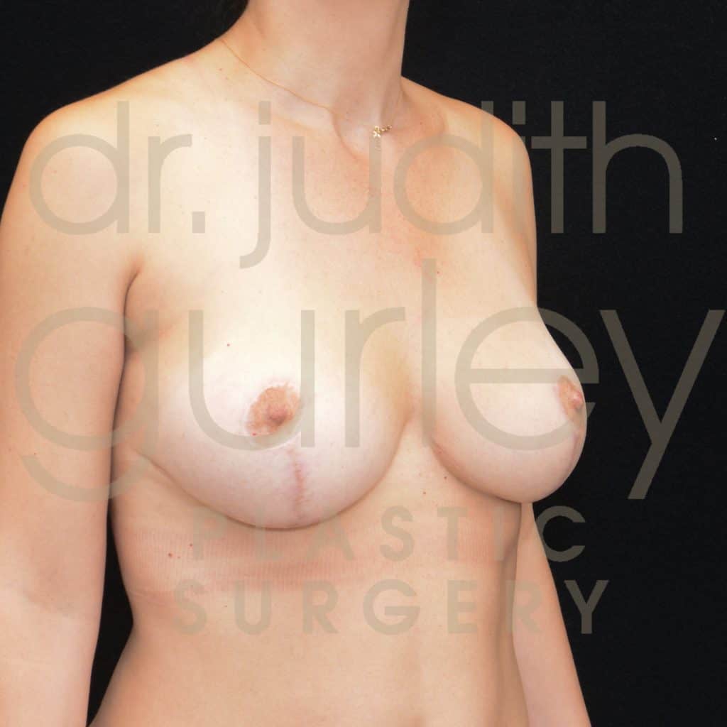 Breast Reduction Surgery Before & After Patient # 2946