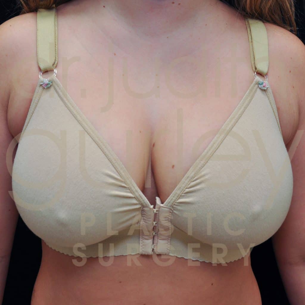 Breast Reduction Surgery Before and After Results