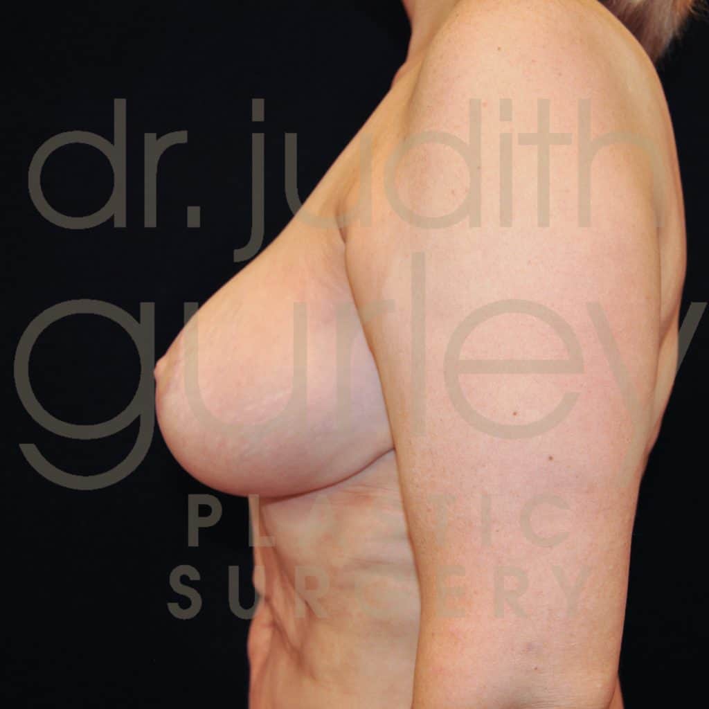 Breast Reduction Surgery Before and After Results