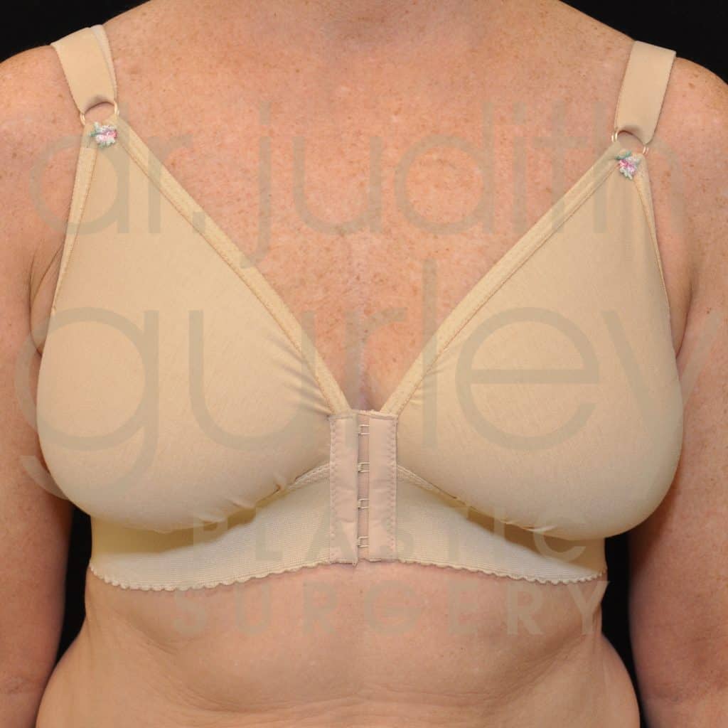 Breast Reduction Surgery Before & After Patient # 4883