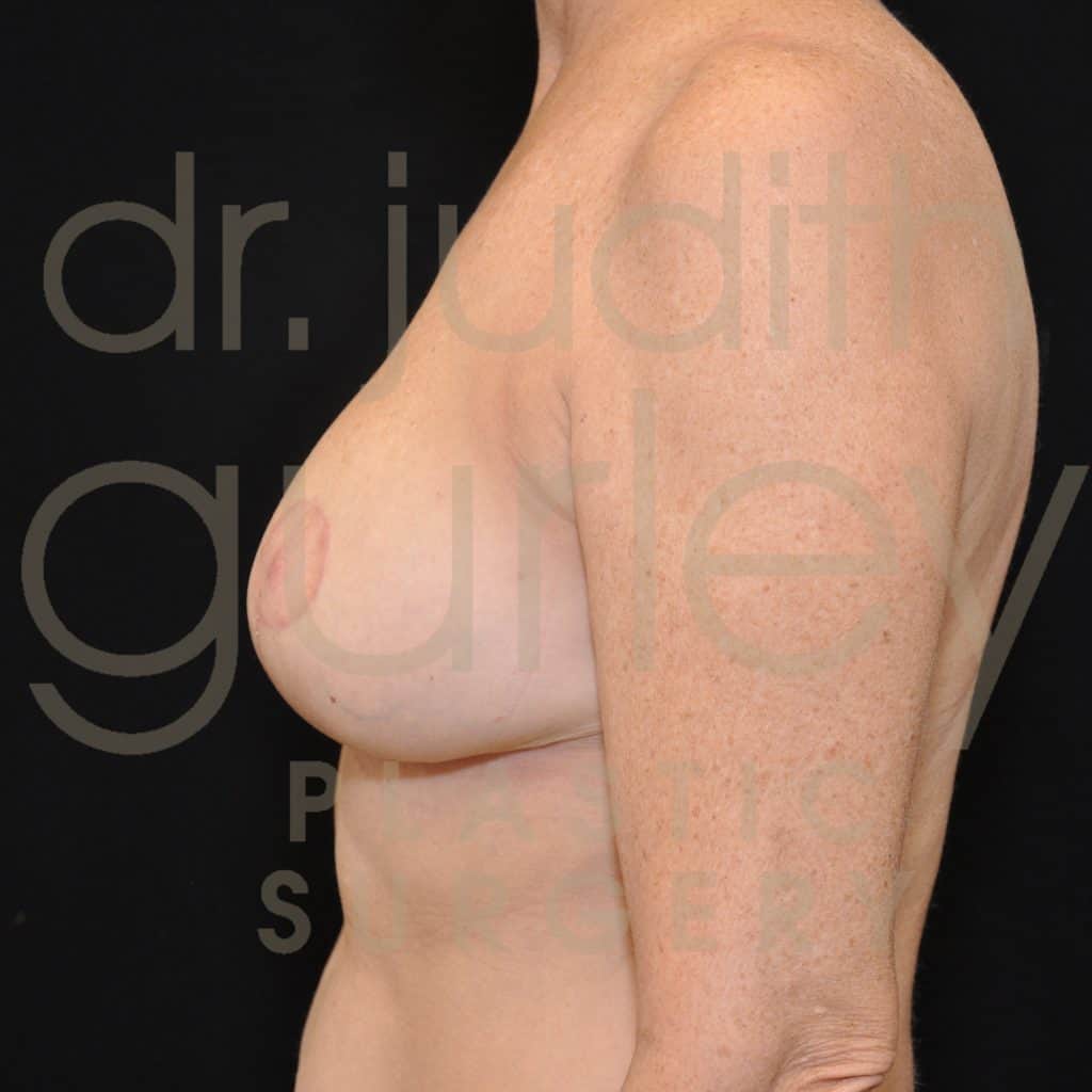Breast Reduction Surgery Before & After Patient # 4883