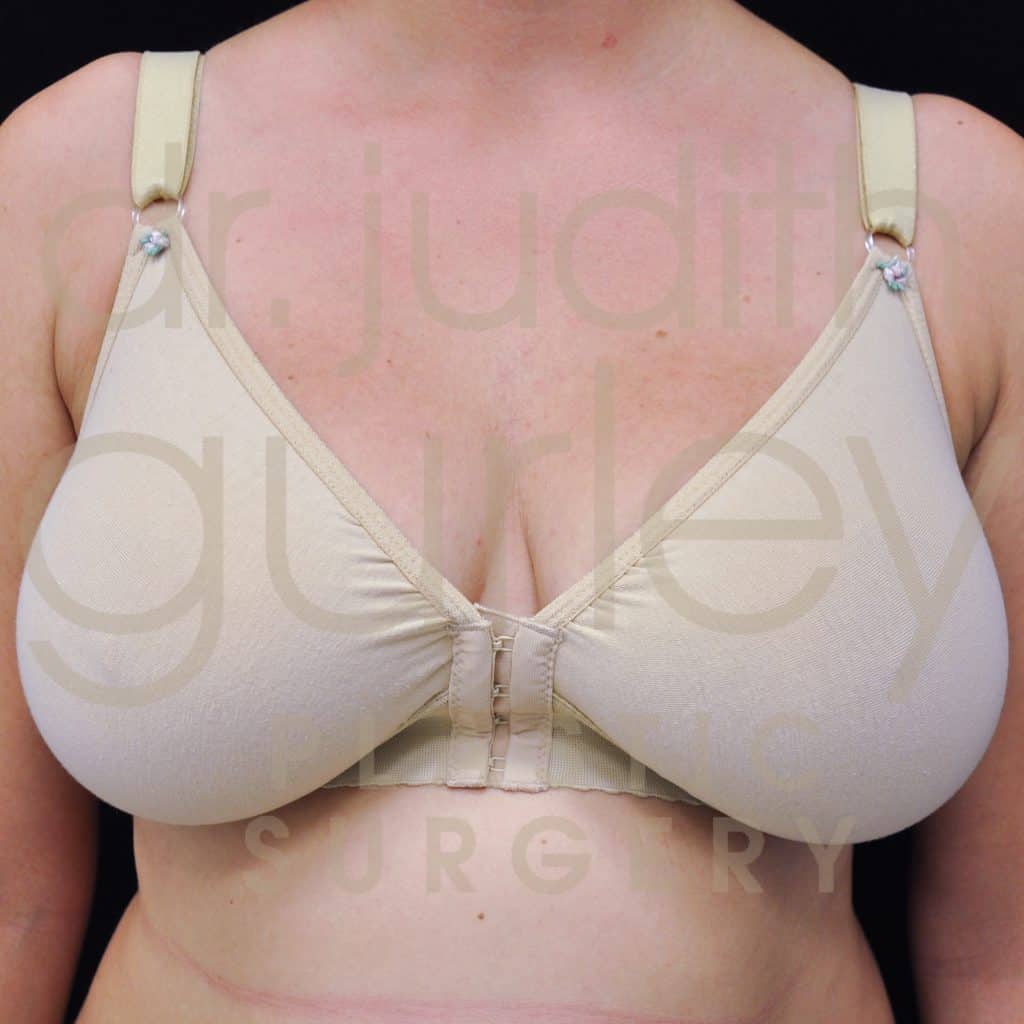 Breast Reduction Surgery Before & After Patient # 5993