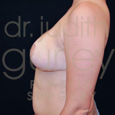 Breast Reduction Surgery Before & After Patient # 5993