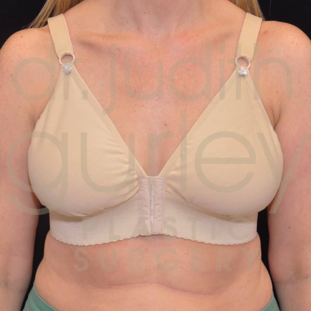 Breast Reduction Surgery Before & After Patient # 7074