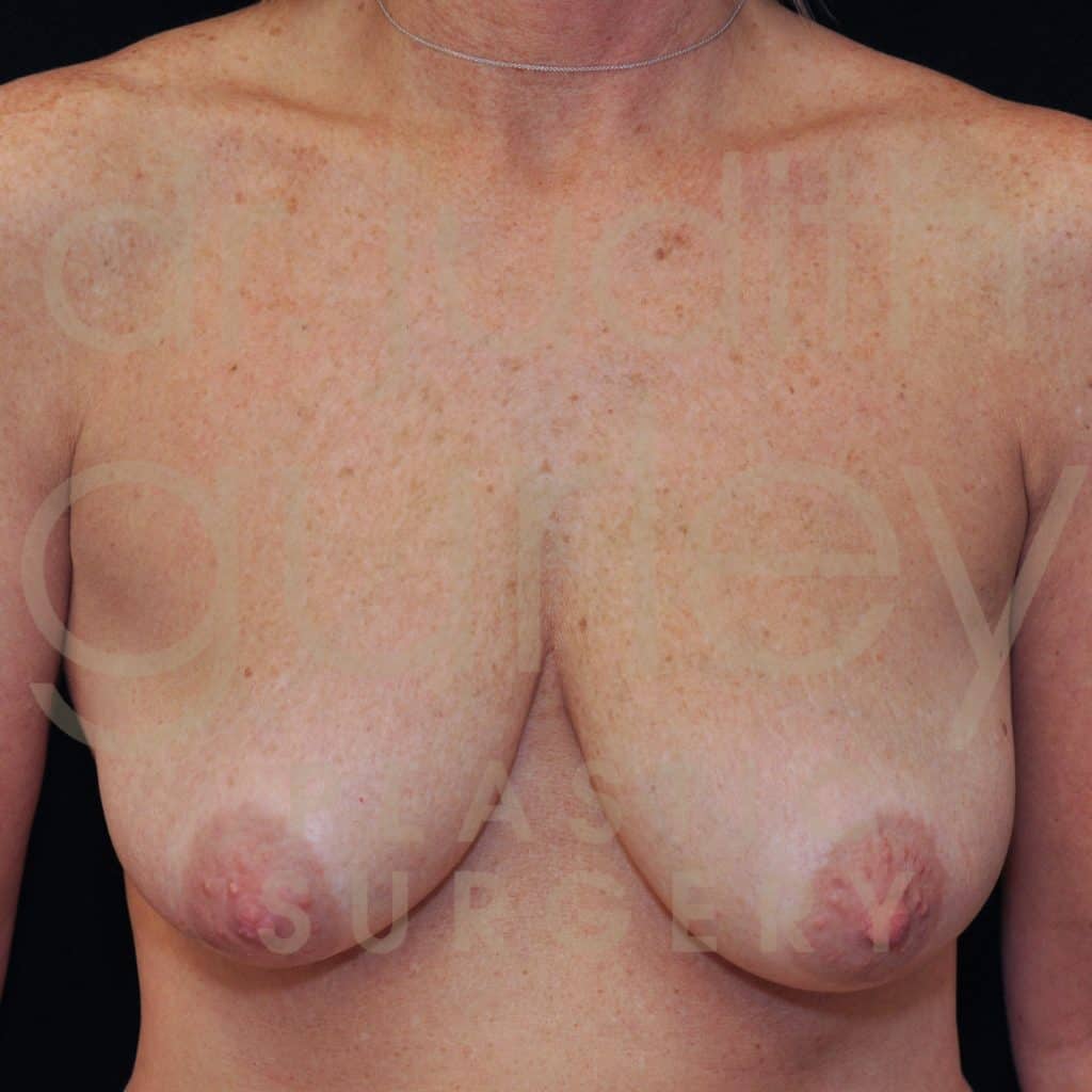 Breast Lift Before & After Patient #1622