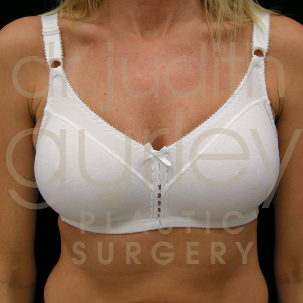 Breast Lift Before & After Patient #5028