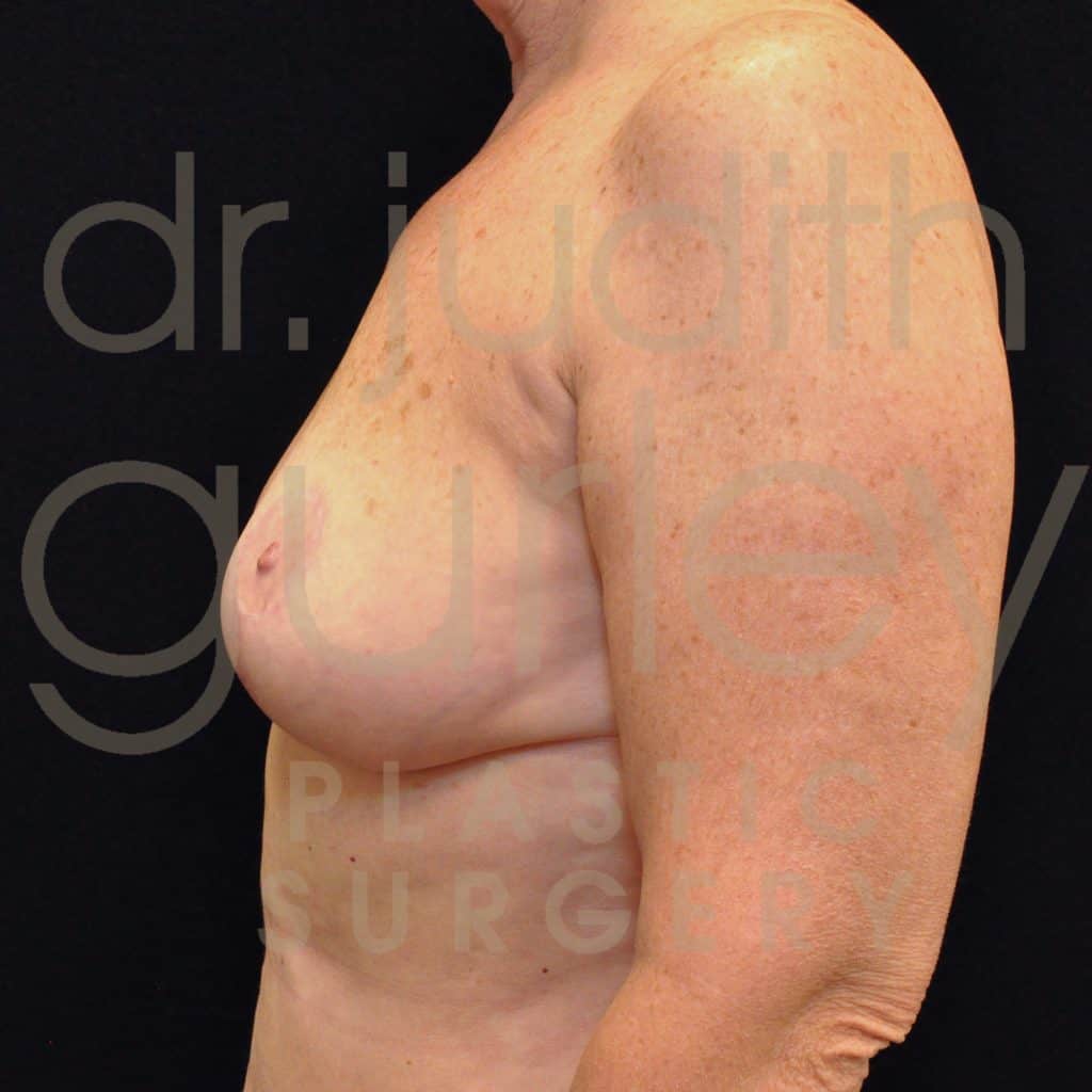 Breast Lift Before & After Patient #1730