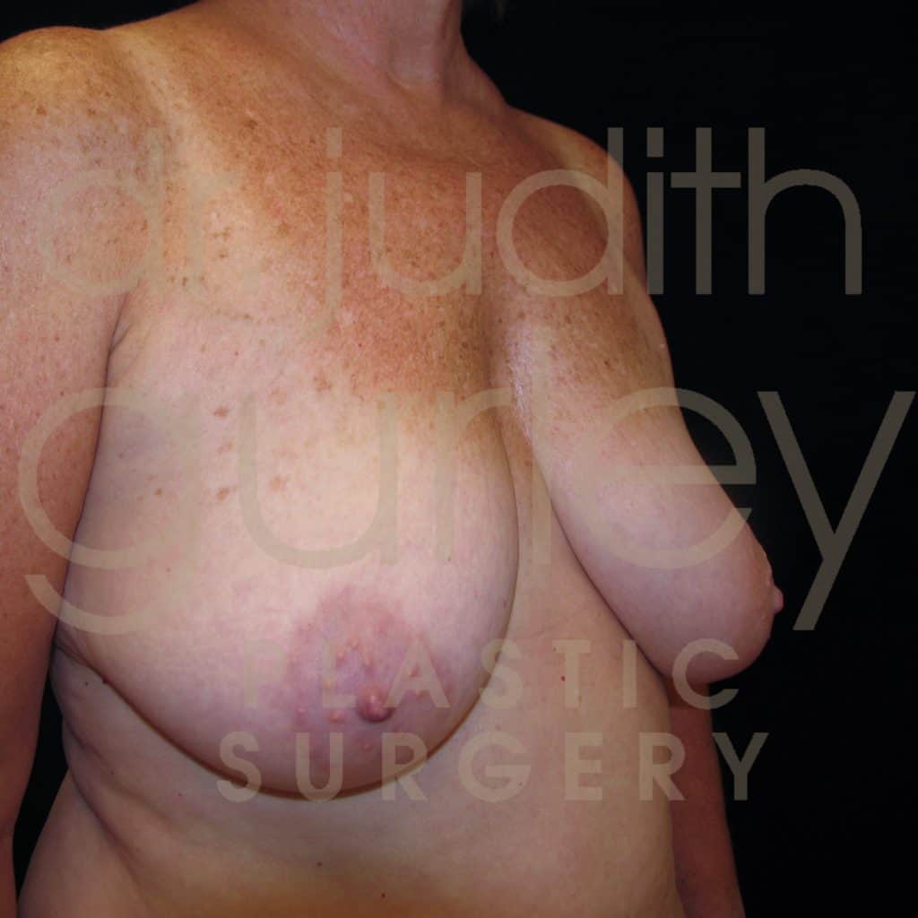 Breast Lift Before & After Patient #1730