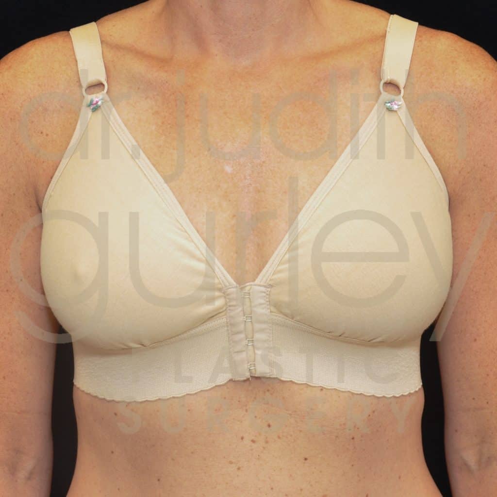 Breast Lift Before & After Patient #1824