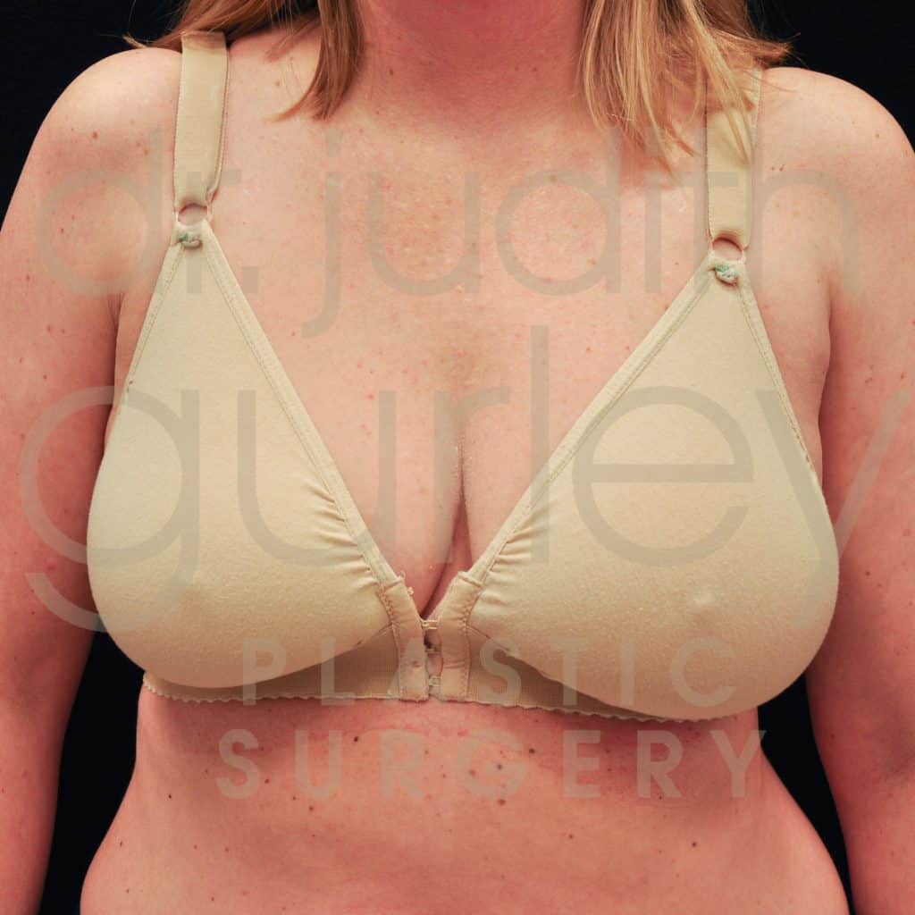 Breast Augmentation and Lift Before & After Patient #3119