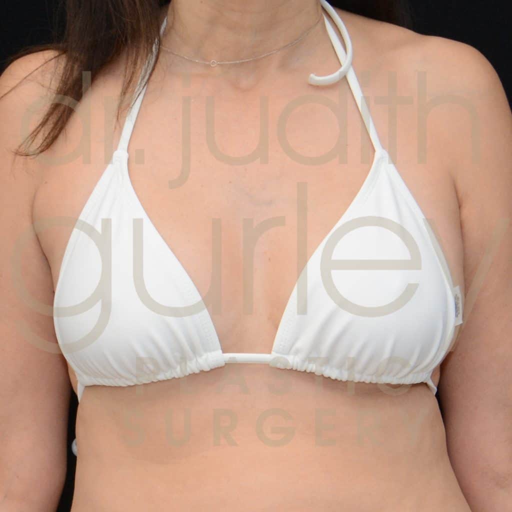 Breast Implant Removal / Replacement Before and After Results