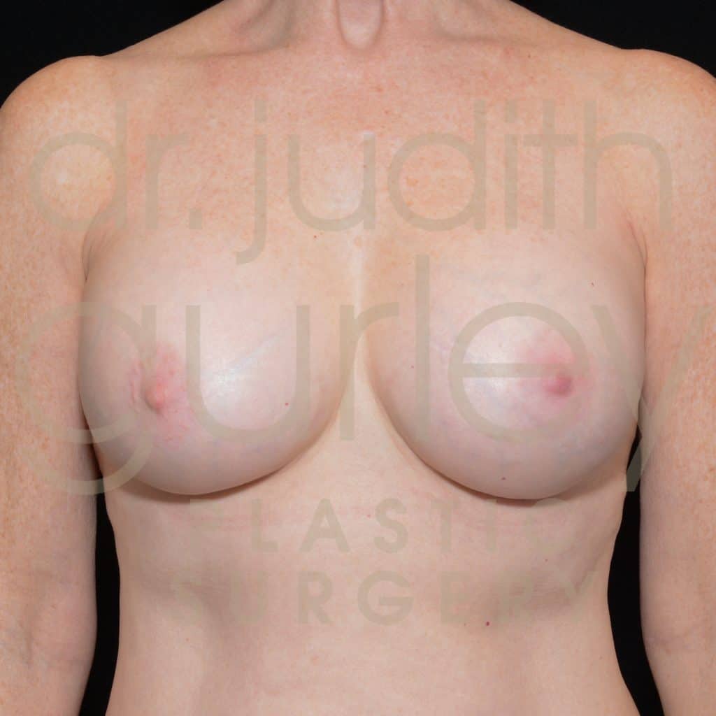 Breast Implant Removal / Replacement Before and After Results