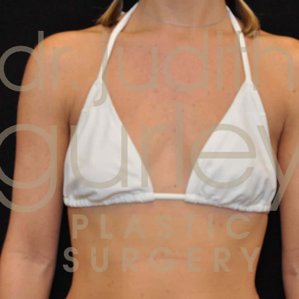 Breast Augmentation Before & After Patient #1339