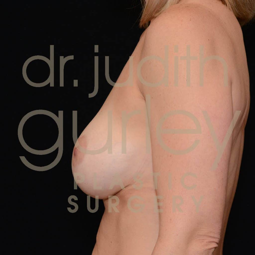 Breast Augmentation Before & After Patient #1669
