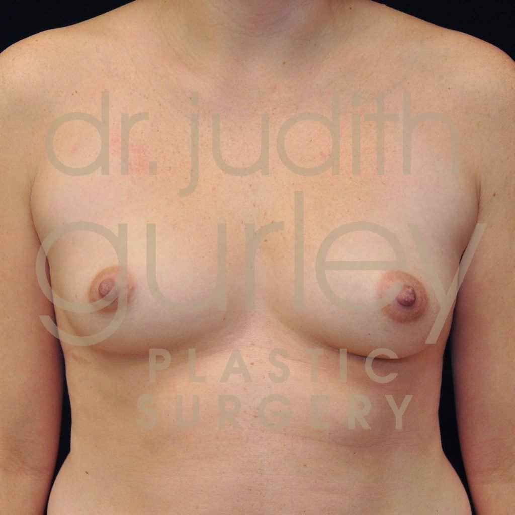 Breast Augmentation Before & After Patient #1958