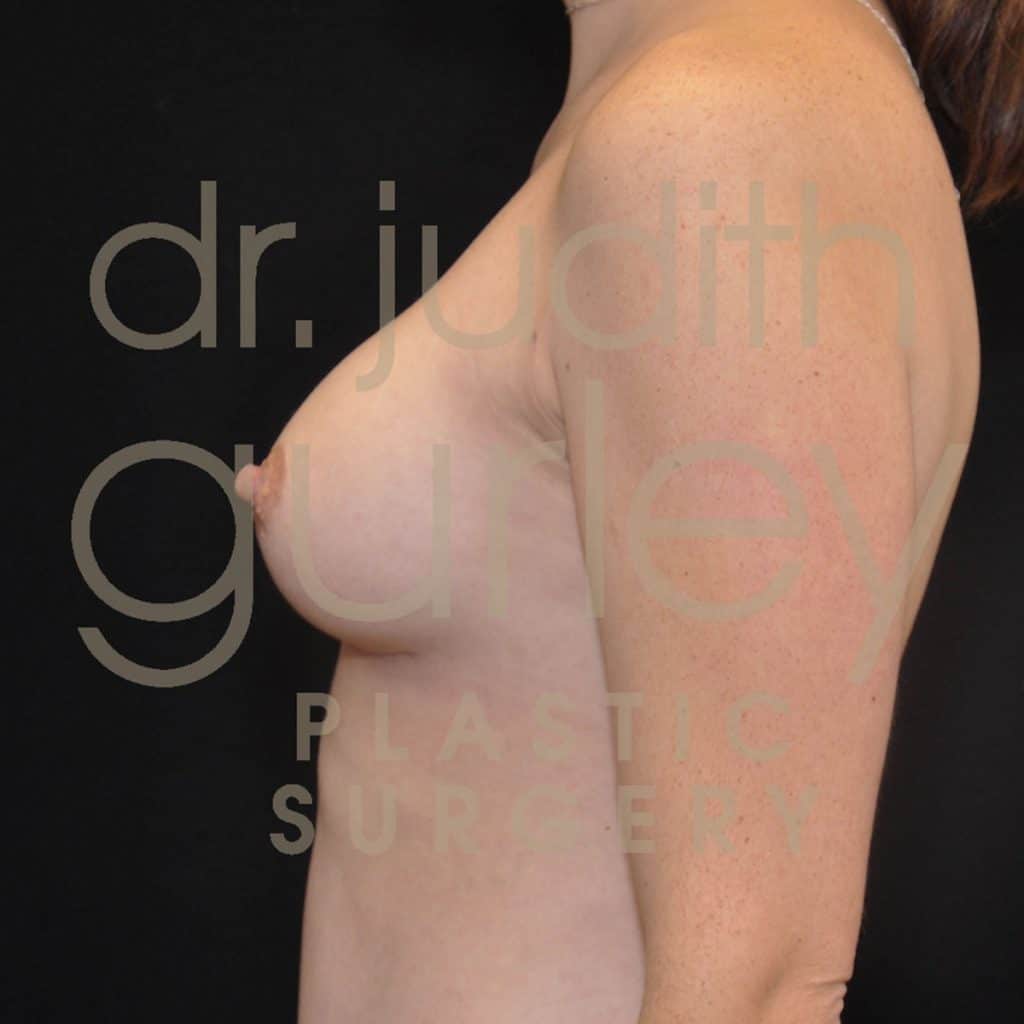 Breast Augmentation Before & After Patient #2101