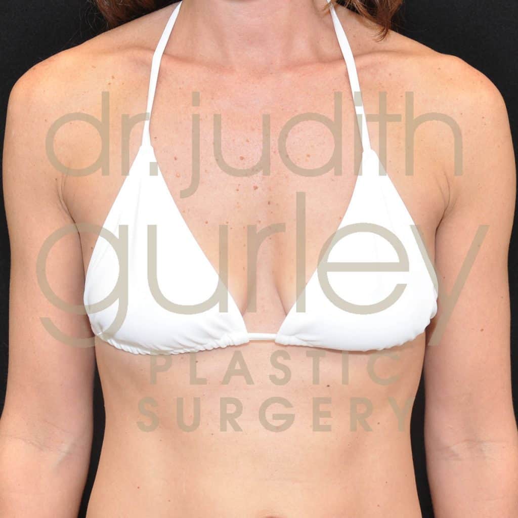 Breast Augmentation Before & After Patient #2387