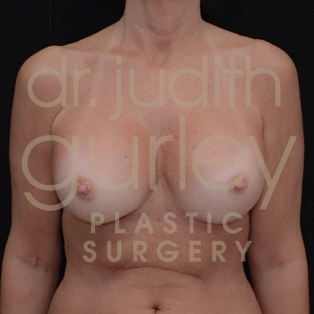Breast Augmentation Before & After Patient #2998