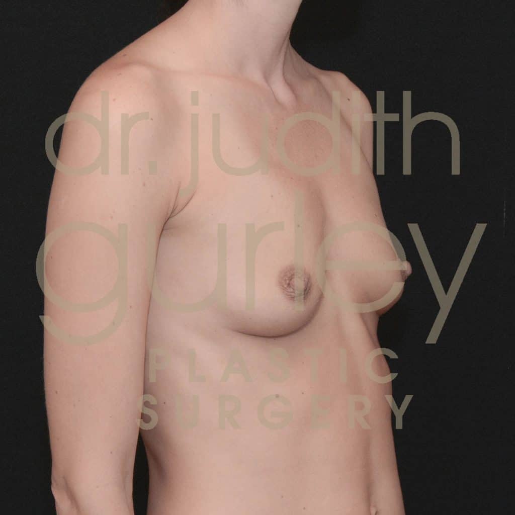 Breast Augmentation Before & After Patient #3562