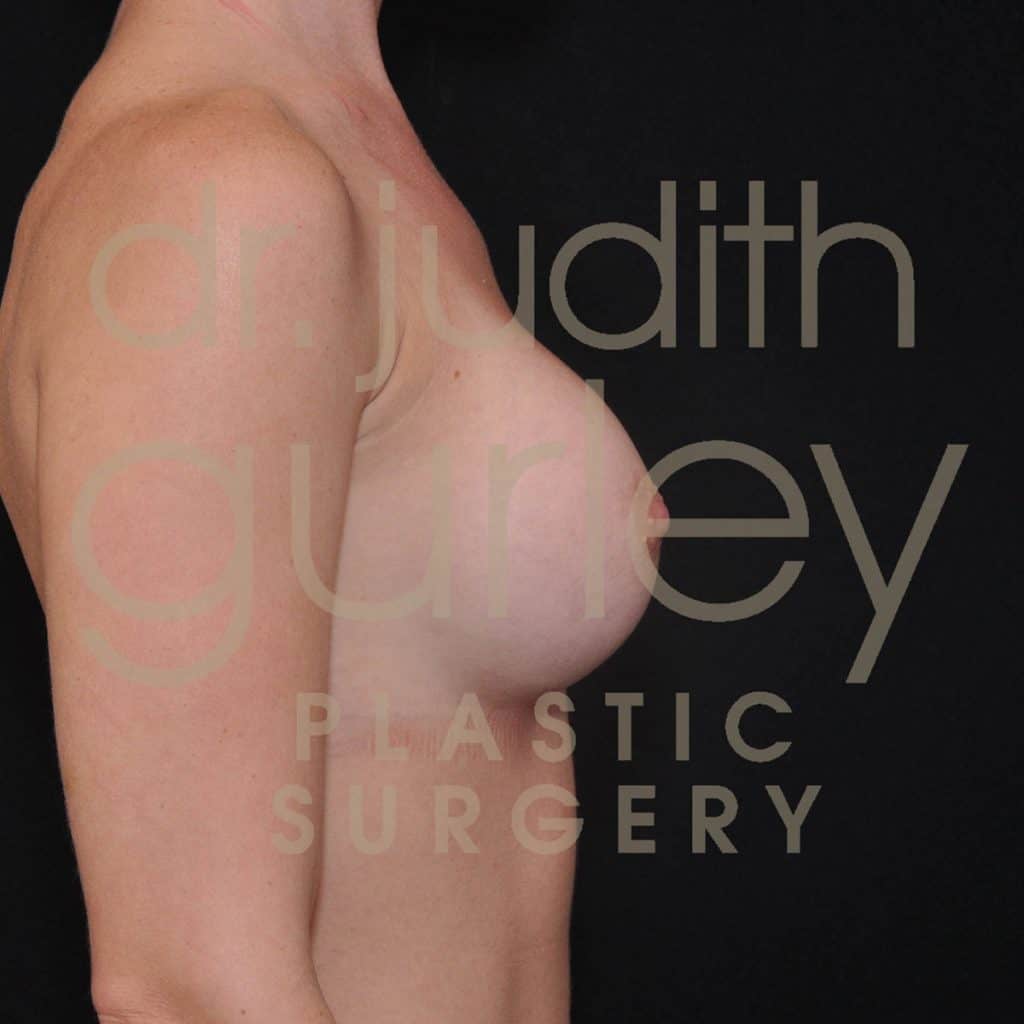 Breast Augmentation Before & After Patient #4682