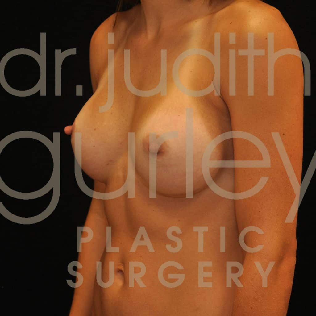 Breast Augmentation Before & After Patient #4932
